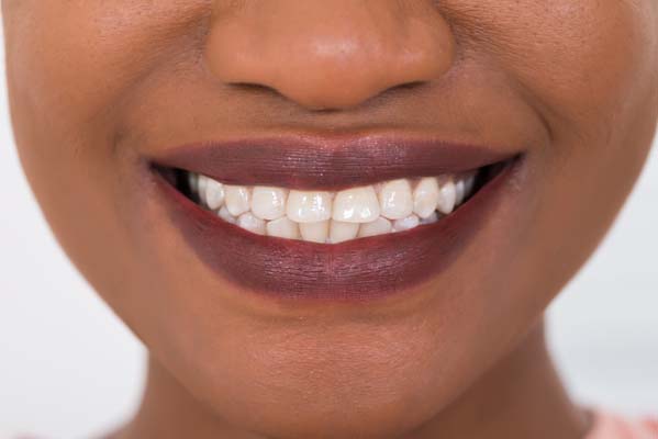 Dental Bonding To Improve Appearance Of Front Teeth