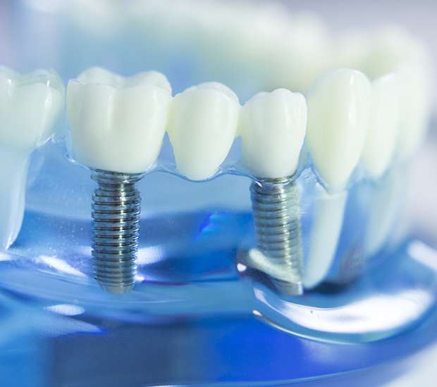 Danvers Dental Implants
