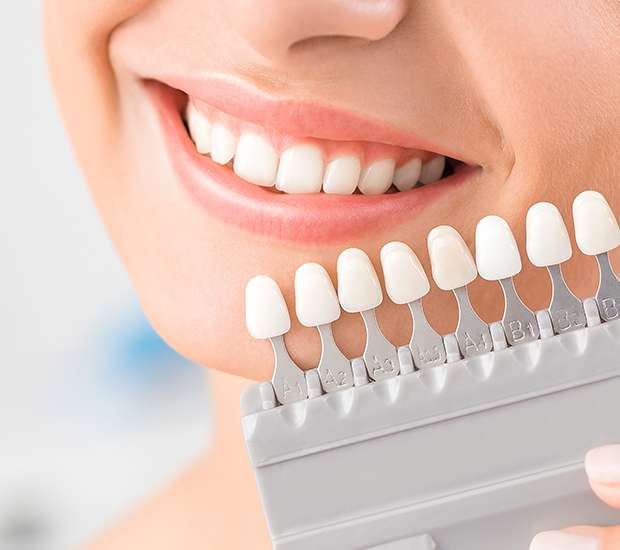 Danvers Dental Veneers and Dental Laminates