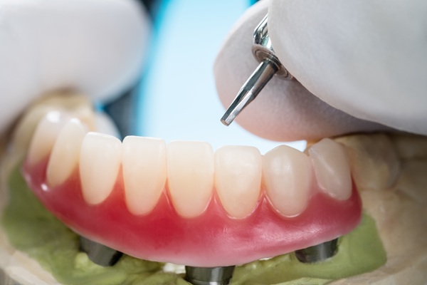 Implant Supported Dentures: What They Are And How They Work