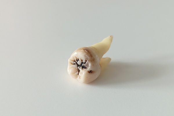 Dos And Don&#    ;ts Of Tooth Extraction Aftercare