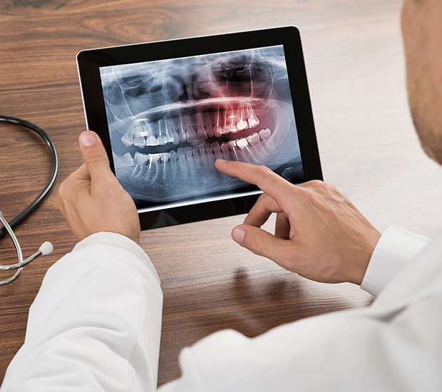 Danvers Types of Dental Root Fractures